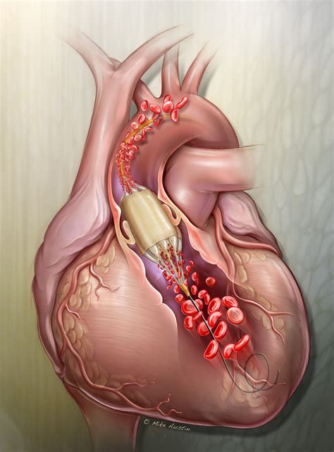 valvuloplasty Archives - Mike Austin | Internal Art Medical Illustration