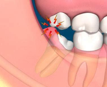 pericoronitis smilescare dental education oral health blog