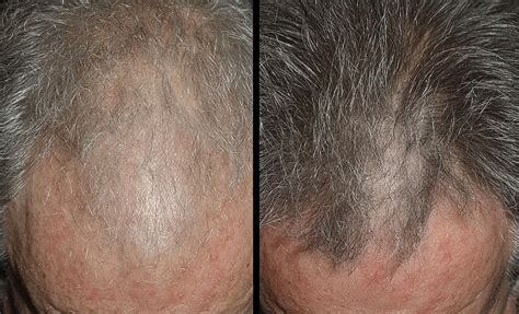 how long does it take for minoxidil to absorb