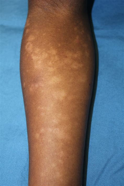 Pityriasis Lichenoides – Digital Dermatology Atlas