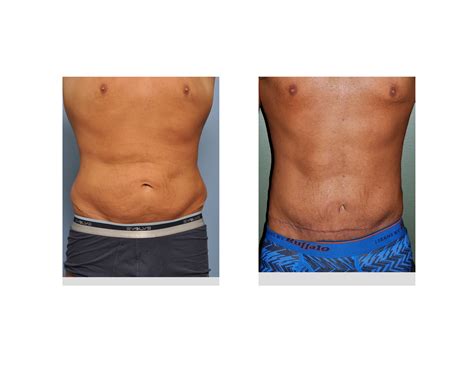Tummy Tuck Before And After Weight Loss