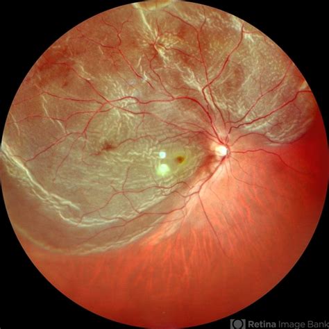 retina detachment retina image bank