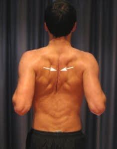 Ascent Physical Therapy: EXERCISE OF THE WEEK - Shoulder Blade Squeeze