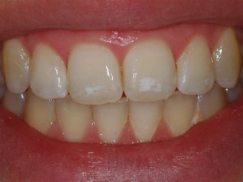 Removing White Spots From Your Teeth | Nundah Village Dental
