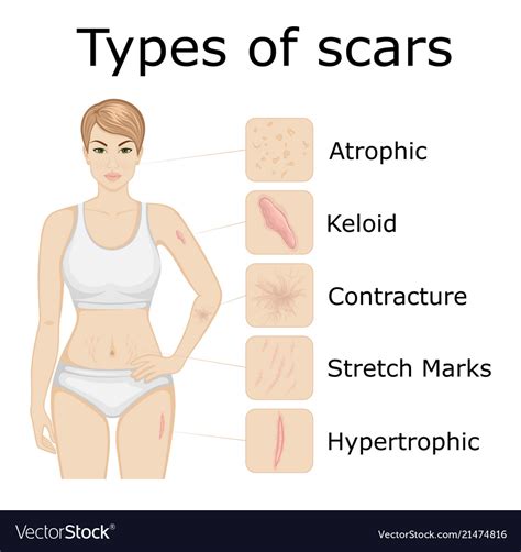 Types of scars Royalty Free Vector Image - VectorStock