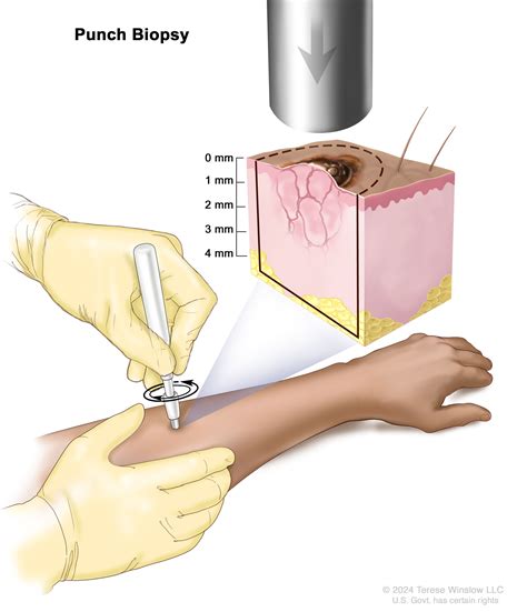 Melanoma | Surgical Innovations
