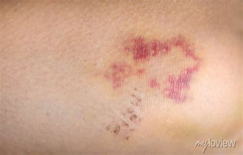 bruises   human body severe bruise  impact bruising posters