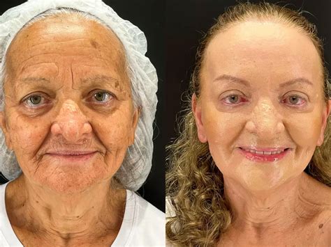 Peeling Fenol Antes E Depois - Peeling de Fenol - Antes e Depois | Focalizando