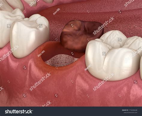 31 imágenes de Alveolitis seca - Imágenes, fotos y vectores de stock ...