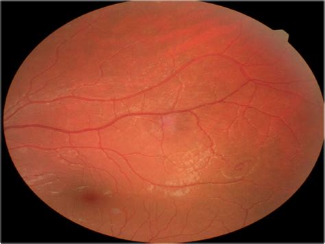 retinal angioma  von hippel lindau disease  case report annals
