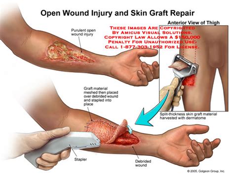 AMICUS Illustration of amicus,surgery,open,wound,injury,skin,graft ...