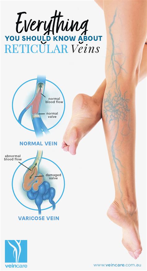 Everything You Should Know About Reticular Veins - VeinCare - Vein Care Treatments Melbourne