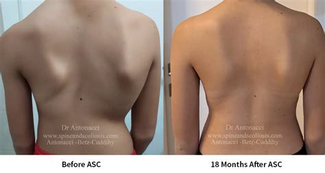 Scoliosis Surgery Before and After