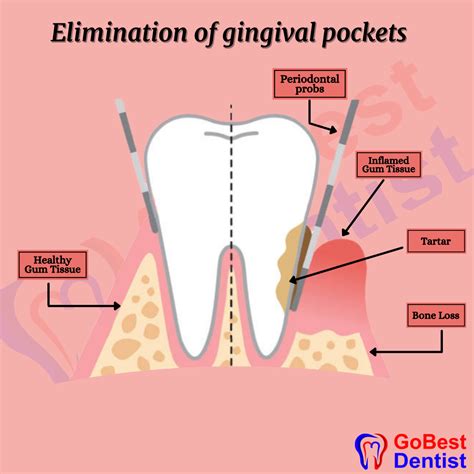 objectives  periodontal flap surgery antoi