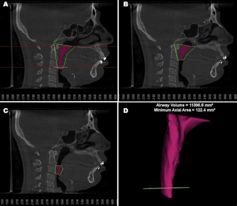 delimitation  measurement  pas  pas total segment  pas