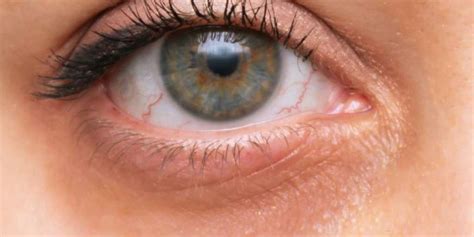 5 Effective Ways To Relax Tired Eyes Instantly | Onlymyhealth