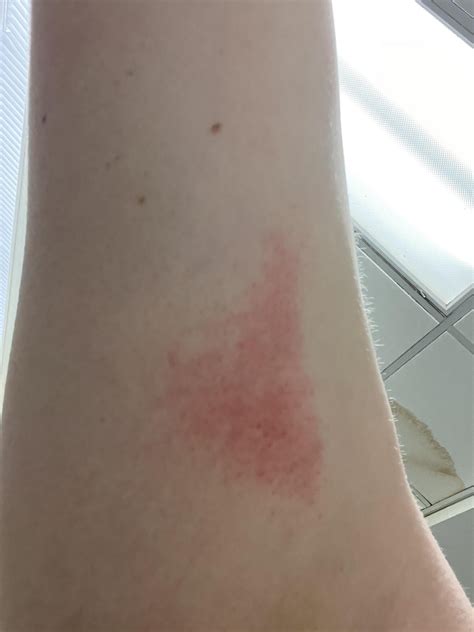 Gnarly friction rash on under-arm from swimming : r/Swimming