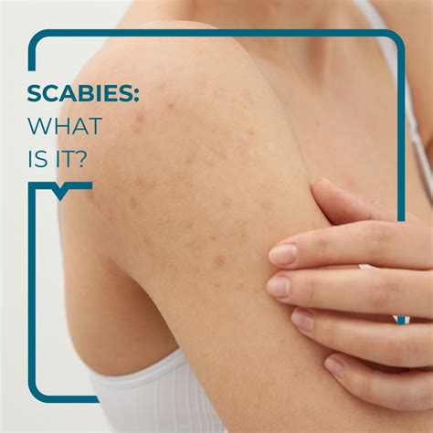 crusted scabies  scalp symptoms
