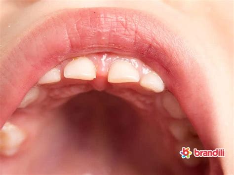 Dente Nascendo Da Diarréia - Dentinho nascendo? 9 sintomas e dicas para aliviar o bebê