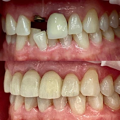 Before and After Gallery | Bespoke Dental Fulham