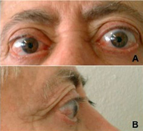 Bilateral metastatic melanoma to the extraocular-muscles simulating ...
