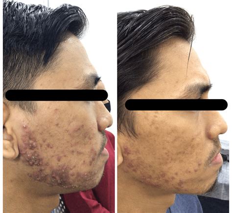 quickest   solve acne klinik estetik kulit laser kecantikan