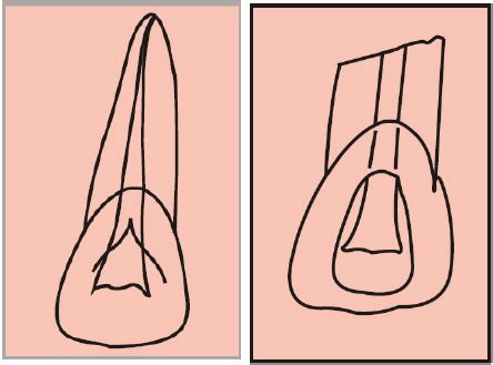 Maxillary Central Incisor - Endodontics and Oral Implantology