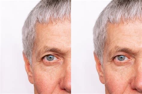 Pálpebra Caída Antes E Depois - Foto recortada do rosto de um homem idoso com pálpebra superior caída ...