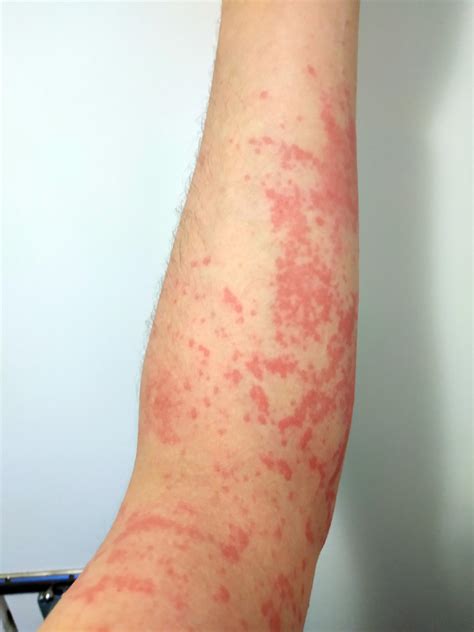 123 best Celiac Disease images on Pholder | Celiac, Glutenfree and
