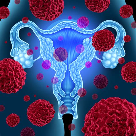 Endometrial Cancer: Symptoms, Staging, Treatment & More