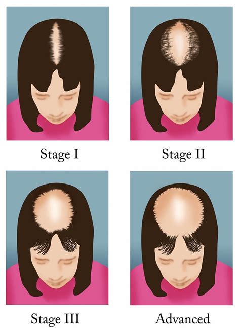 How To Fix Female Pattern Hair Loss Tips Faqs And Hair Care - Best ...