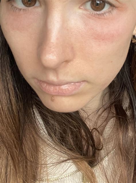 Does this look like an allergy? : r/Allergy