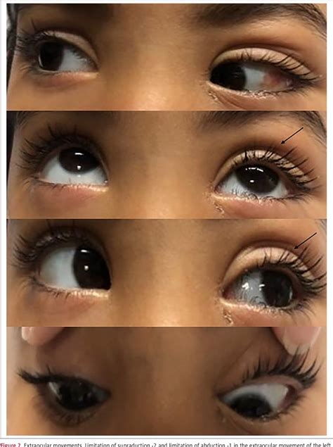 Figure 5 from Painless Orbital Bone Infarction in a Child with Sickle