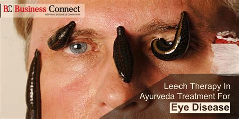 All About Leech therapy | Leech Therapy For Eye Treatment