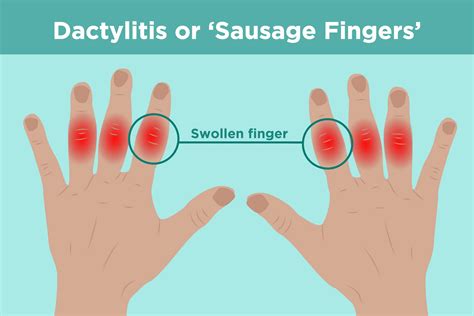 swollen knuckle finger    treatments explained