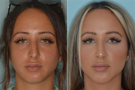 nose wet  rhinoplasty  dennis penn blog