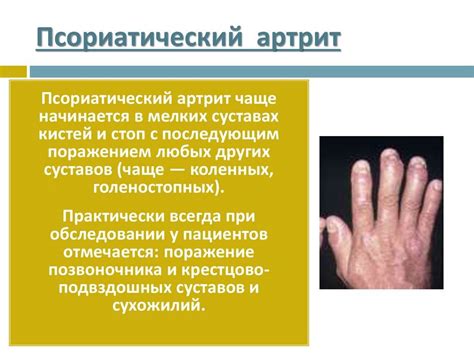 Диагностика псориатического артрита - рентген и другие методы исследования