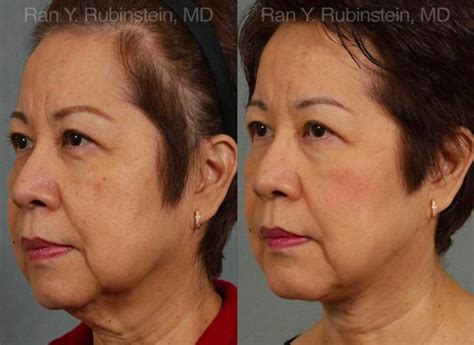 anatomical challenges  surgical neck rejuvenation