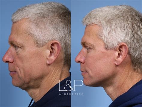 Male Facelift & Neck Lift at L&P Aesthetics.