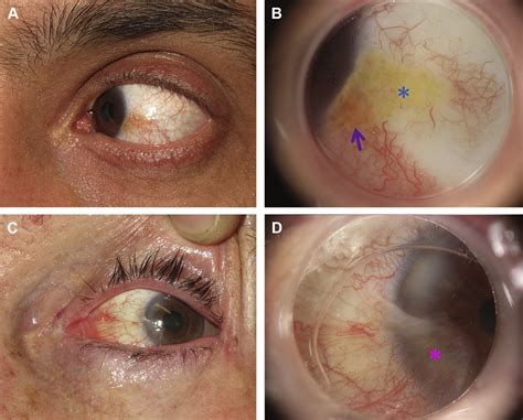 Dermoscopy for the Diagnosis of Conjunctival Lesions - Dermatologic Clinics