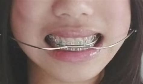 correct  smile  headgear braces article approve