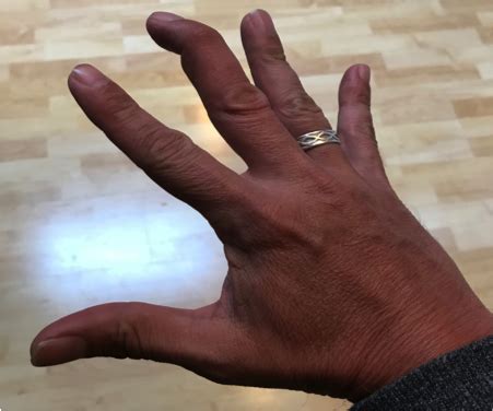 minor care series finger tendon injuries taming  sru