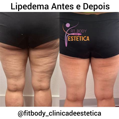 Lipedema Antes E Depois Do Tratamento - A Situacao Antes E Depois Antes E Depois De Lipolaser Na Up Clinic