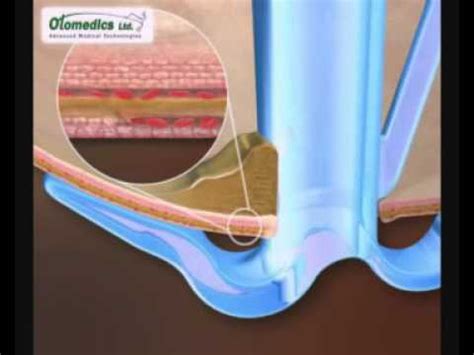 Tympanostomy Tube