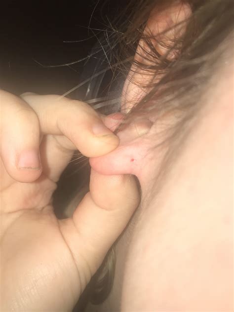 “Minor” Blackhead on my ear left this gaper! Sorry, didn’t film bc I