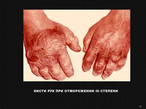 Отморожения. Классификация - презентация онлайн