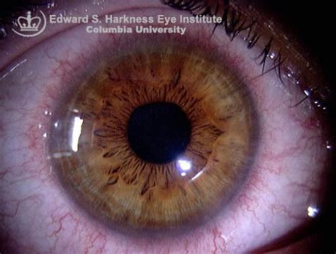 Corneal Neovascularization | Vagelos College of Physicians and Surgeons