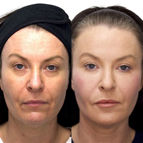 Non Surgical Face Lift | TLC Medical Aesthetics