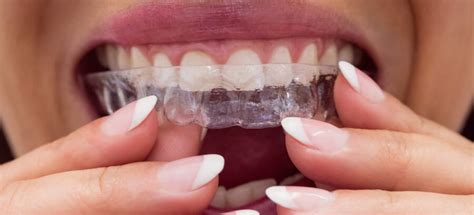 Quanto Tempo Ficar Com A Moldeira De Clareamento 22 - Clareamento Dental Com Moldeira: o que é e como funciona