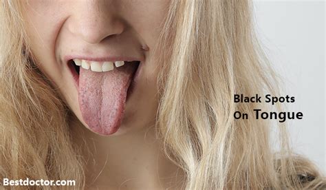 Black Spot On Tongue - astonishingceiyrs